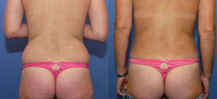 Liposuction: Case 5