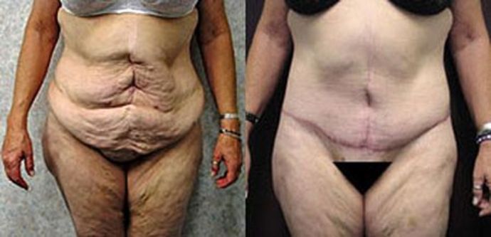 Tummy Tuck: Case 5