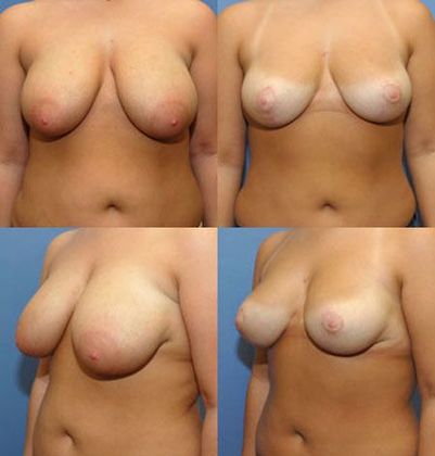 Breast Reduction: Case 5