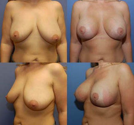 Breast Lift: Case 5: Oklahoma City