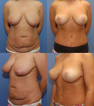 Tummy Tuck: Case 6