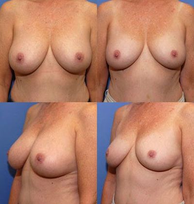 Breast Reduction: Case 6