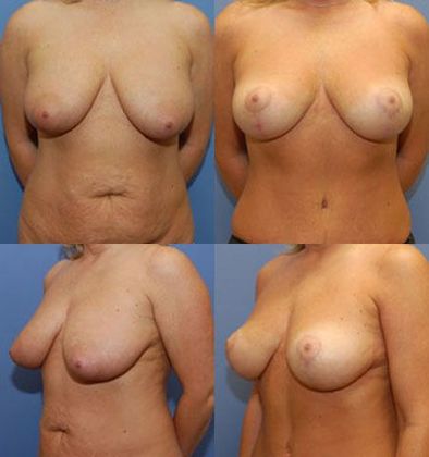 Breast Lift: Case 6: Oklahoma City