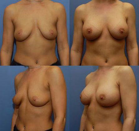Case 064