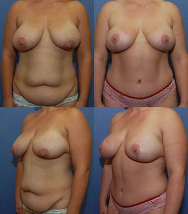 Tummy Tuck: Case 7