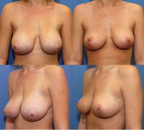 Breast Reduction: Case 7