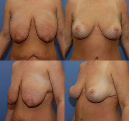Breast Lift: Case 7: Oklahoma City