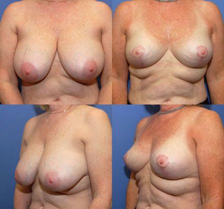 Breast Reduction: Case 8
