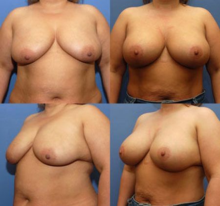 Breast Lift: Case 8: Oklahoma City