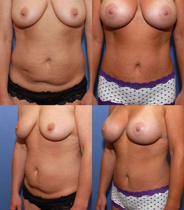 Tummy Tuck: Case 9