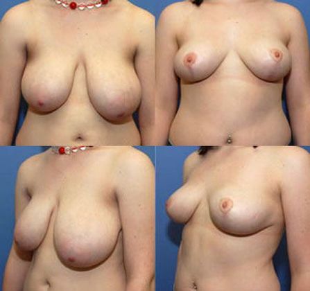 Breast Reduction: Case 9
