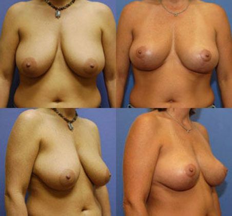 Breast Lift: Case 9: Oklahoma City