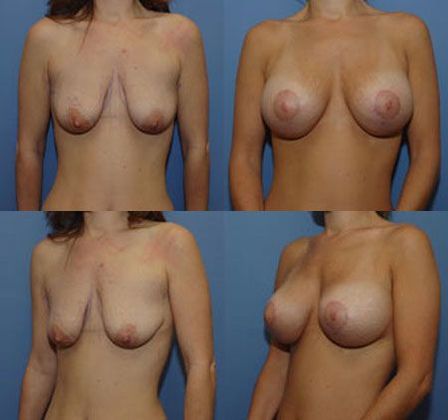 Case 094